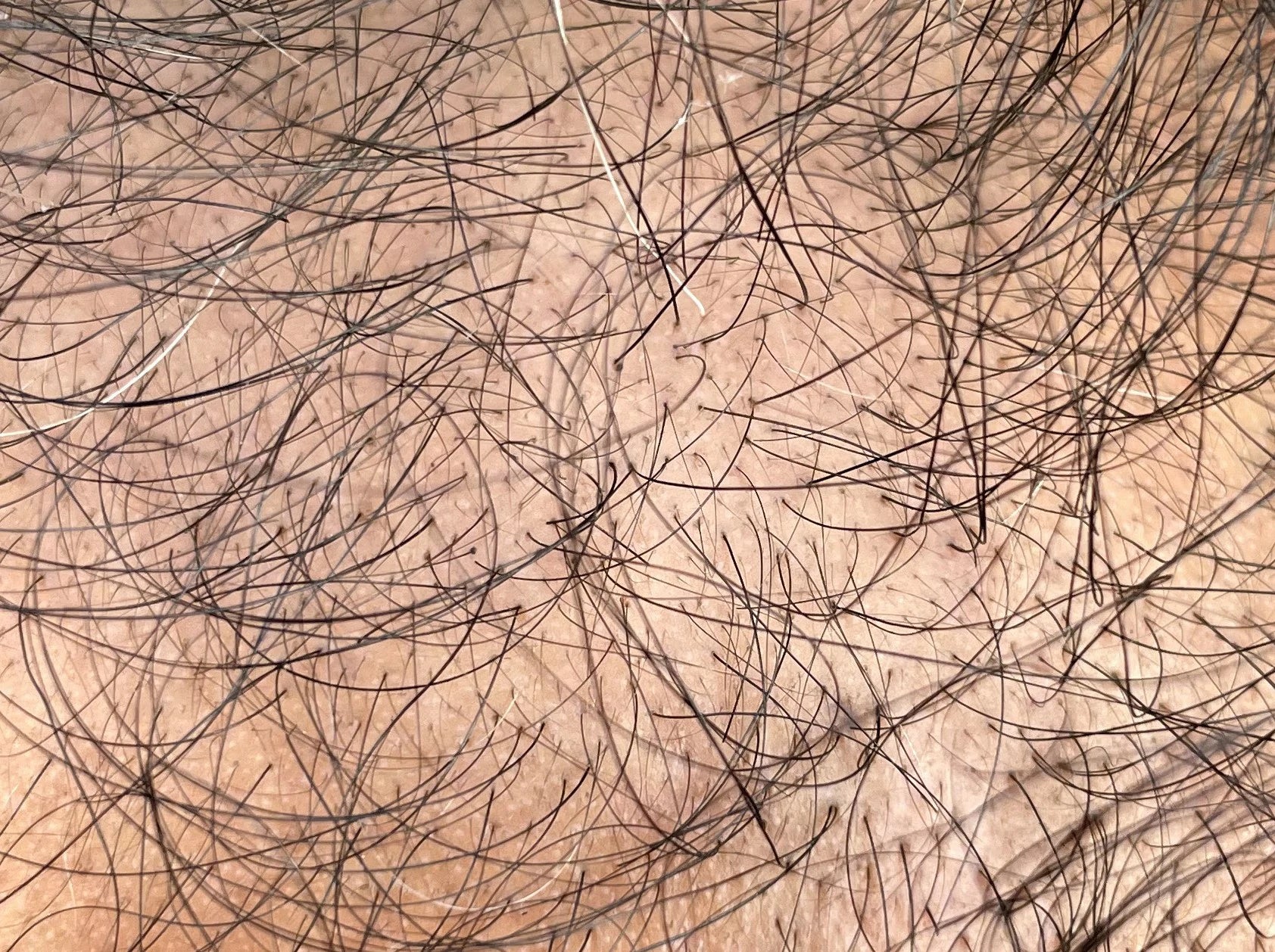 After photo showing new baby hairs and improved density