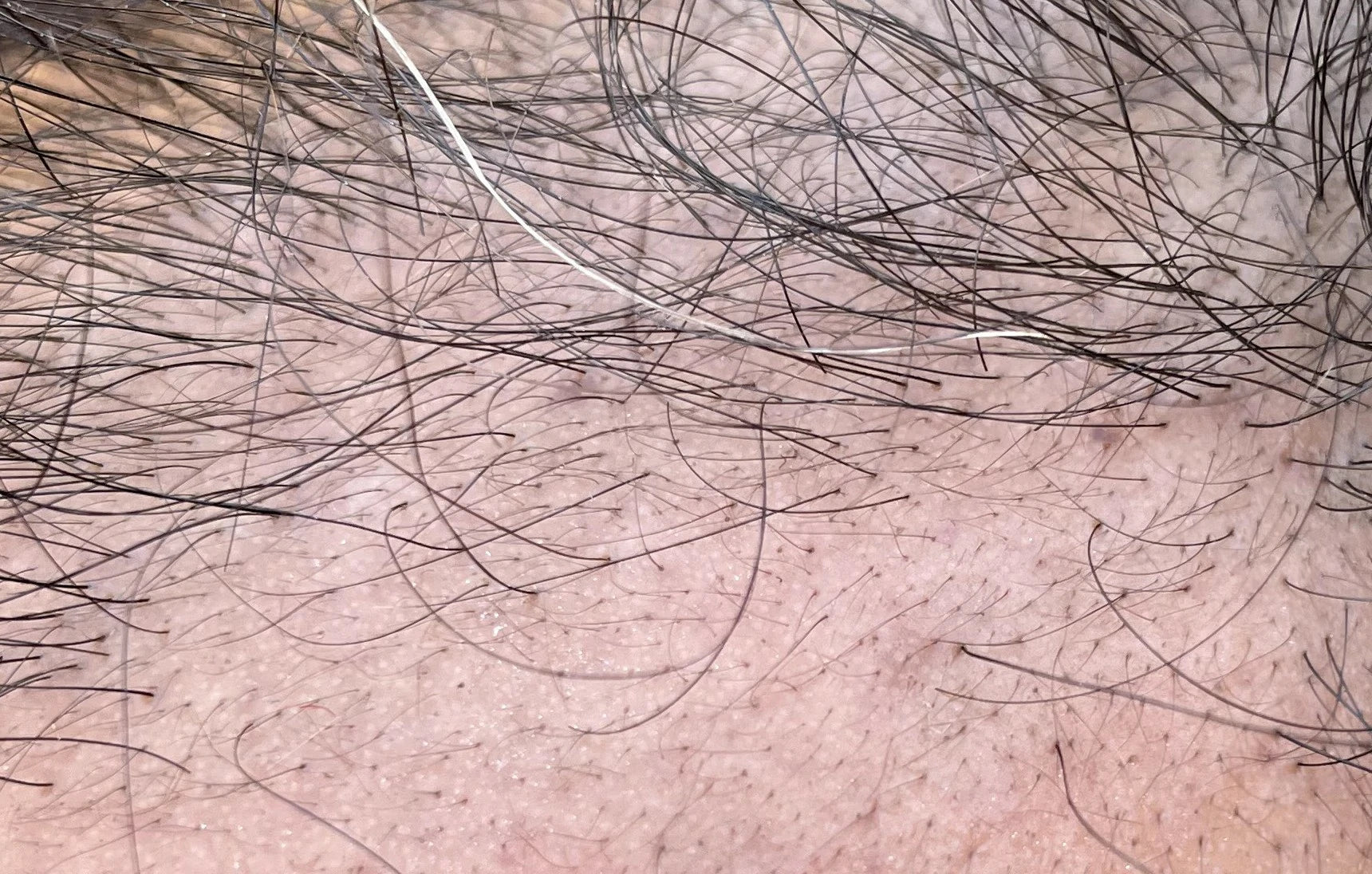 After photo showing new baby hair growth